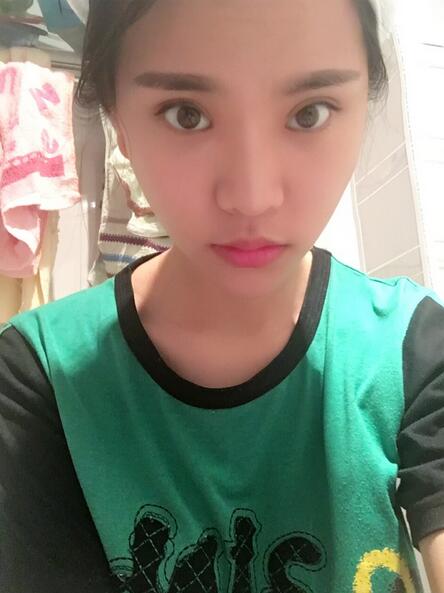 鄭州悅美切開雙眼皮半個(gè)月恢復(fù)日記