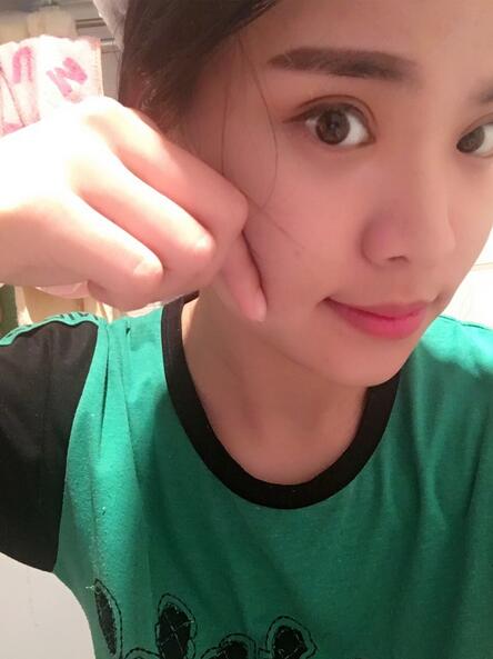 鄭州悅美切開雙眼皮半個(gè)月恢復(fù)日記