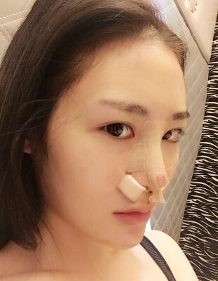 在隆鼻整形之后終于有了超精致的鼻子，尹度龍做的喲