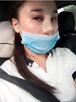 膨體隆鼻改變了我的塌鼻子，整體都精致不少