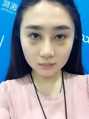 膨體隆鼻改變了我的塌鼻子，整體都精致不少