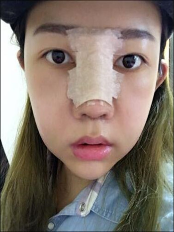 做了隆鼻整形手術果真的很不錯 大家快來看看吧