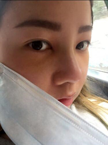 做了隆鼻整形手術果真的很不錯 大家快來看看吧