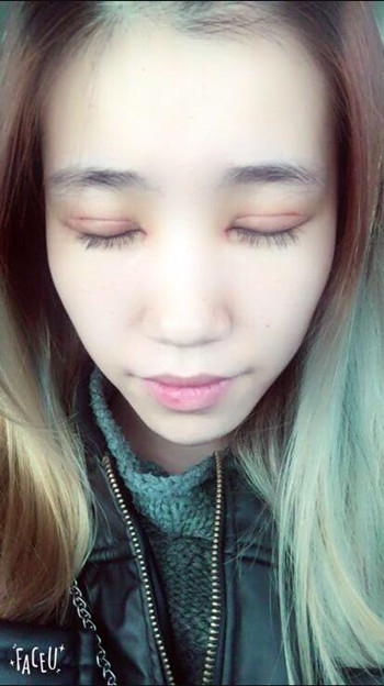 做了全切雙眼皮 整個眼睛都變大了氣質也不一樣了