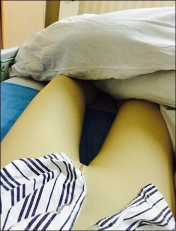 大腿吸脂手術真的是解決很難減下去的良藥 看我得果就知道