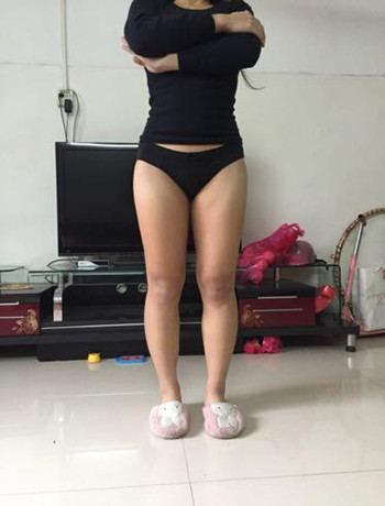 大腿吸脂手術真的是解決很難減下去的良藥 看我得果就知道