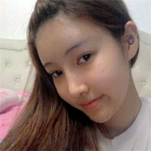 去年做了隆鼻整形，分享恢復(fù)過程和前后對比果圖片哦，