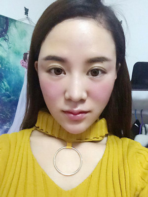 埋線面b提拉一個月之后還是美美噠