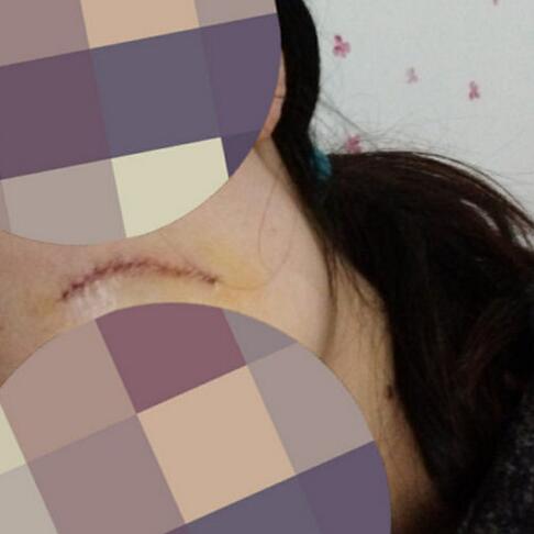 給大家看看我的臉上的手術切除祛疤過程圖片