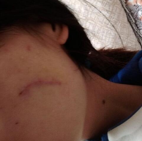 給大家看看我的臉上的手術切除祛疤過程圖片