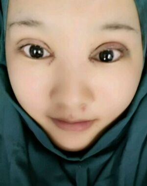 沒(méi)想到切開雙眼皮能這么自然，仿佛天生呀