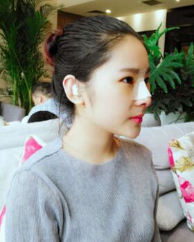 隆鼻整形改變了我整體鼻子的形狀