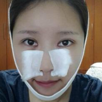 做了埋線雙眼皮、隆鼻、磨下頜角，兩個(gè)月了，分享恢復(fù)照片~