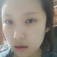 做了埋線雙眼皮、隆鼻、磨下頜角，兩個(gè)月了，分享恢復(fù)照片~