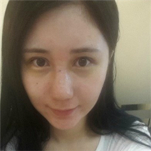 埋線雙眼皮+隆鼻手術(shù)恢復(fù)過程和前后對(duì)比果圖片真實(shí)分享~~~