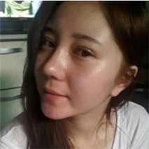 埋線雙眼皮+隆鼻手術(shù)恢復(fù)過程和前后對(duì)比果圖片真實(shí)分享~~~