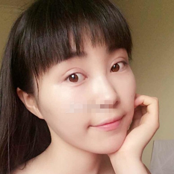 開外眼角手術(shù)一個月了，分享恢復(fù)過程和前后對比果照片~