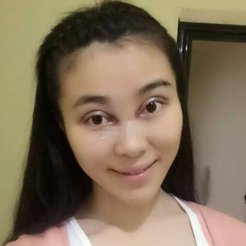 開外眼角手術(shù)一個月了，分享恢復(fù)過程和前后對比果照片~