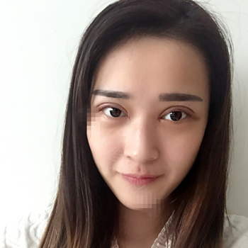 伊美馨做了開內(nèi)眼角和雙眼皮手術(shù)，分享我的術(shù)后果照片~~