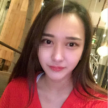 伊美馨做了開內(nèi)眼角和雙眼皮手術(shù)，分享我的術(shù)后果照片~~