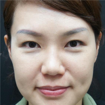 李阿姨眼袋失敗修復(fù)手術(shù)后的果圖，年輕了好幾歲~