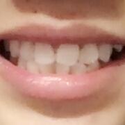 美容冠牙齒修復(fù)，緩解前后過程分享