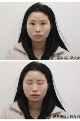 剛做了雙眼皮切開重瞼手術(shù)，恢復(fù)得越來越自然了