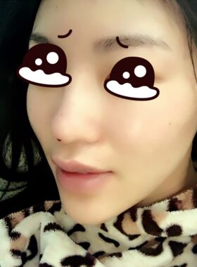 線D隆鼻恢復(fù)過程圖，看看我的果怎么樣