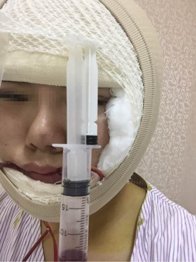 磨骨手術(shù)讓我變成小v臉 果真的很不錯