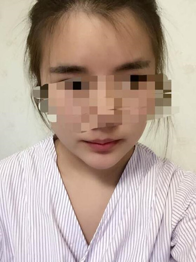 磨骨手術(shù)讓我變成小v臉 果真的很不錯