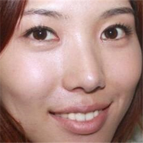 武漢希思特做了埋線法雙眼皮、開內(nèi)眼角和鼻尖移植軟骨整形手術(shù)~