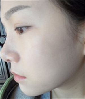 元旦做的光子嫩膚，分享恢復(fù)過程和前后對比果照片哦~