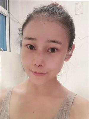 你們看看我做的綜合隆鼻手術(shù)怎么樣