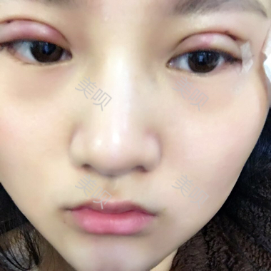一個月時間的切開雙眼皮消腫過程圖分享