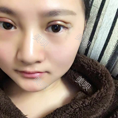 一個月時間的切開雙眼皮消腫過程圖分享
