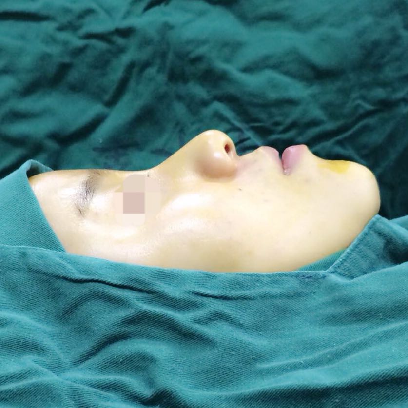 歪鼻矯正手術(shù)前后過程以及恢復(fù)照片對比照