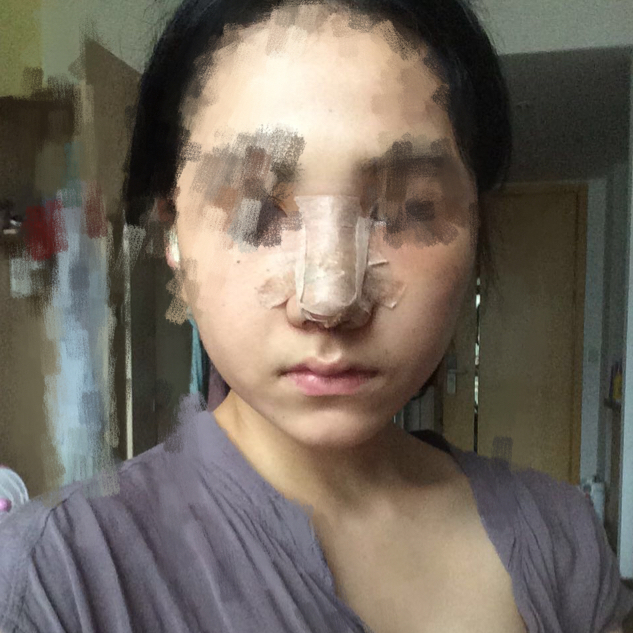 歪鼻矯正手術(shù)前后過程以及恢復(fù)照片對比照