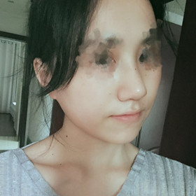 歪鼻矯正手術(shù)前后過程以及恢復(fù)照片對比照