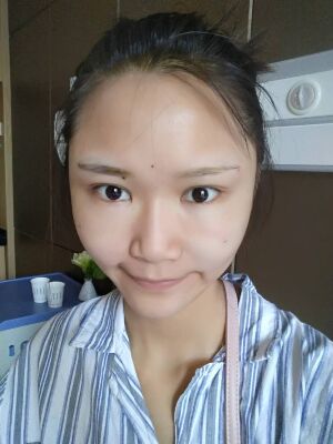 自體脂肪面部填充后恢復，成活率還蠻高的