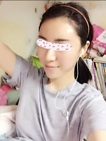 給大家分享一下我的自體脂肪填充全臉經(jīng)歷 內(nèi)有果對(duì)比圖