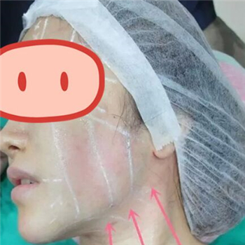 做音波拉皮除皺術(shù)一個月了，分享恢復過程和前后對比果圖片~