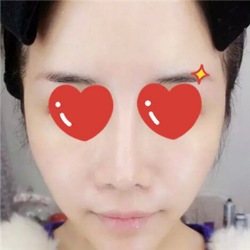 做音波拉皮除皺術(shù)一個月了，分享恢復過程和前后對比果圖片~