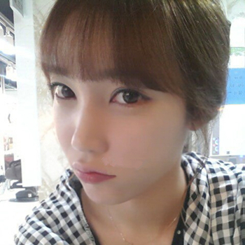 長沙美萊做了磨顴骨手術，分享恢復過程和前后對比果圖片~