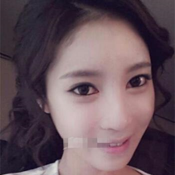 長沙美萊做了磨顴骨手術，分享恢復過程和前后對比果圖片~