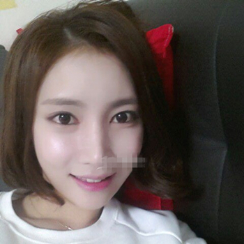 長沙美萊做了磨顴骨手術，分享恢復過程和前后對比果圖片~