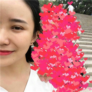 北京美萊做了雙眼皮手術(shù)，分享前后對比果圖片~