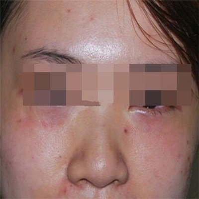 內(nèi)切去眼袋手術(shù)恢復(fù)過程和前后對比果圖片分享，美聯(lián)臣做的哦~