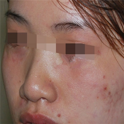 內(nèi)切去眼袋手術(shù)恢復(fù)過程和前后對比果圖片分享，美聯(lián)臣做的哦~