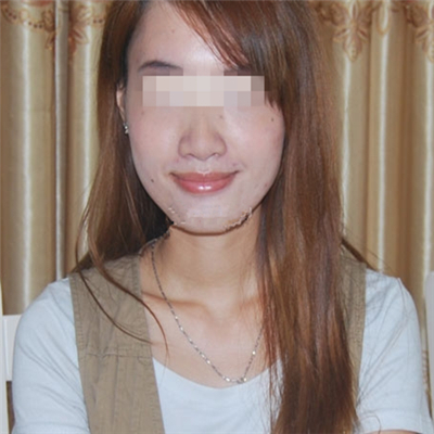 內(nèi)切去眼袋手術(shù)恢復(fù)過程和前后對比果圖片分享，美聯(lián)臣做的哦~