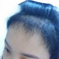 在雍禾植發(fā)醫(yī)院做微創(chuàng)微創(chuàng)植發(fā)經(jīng)歷分享，植發(fā)果很好